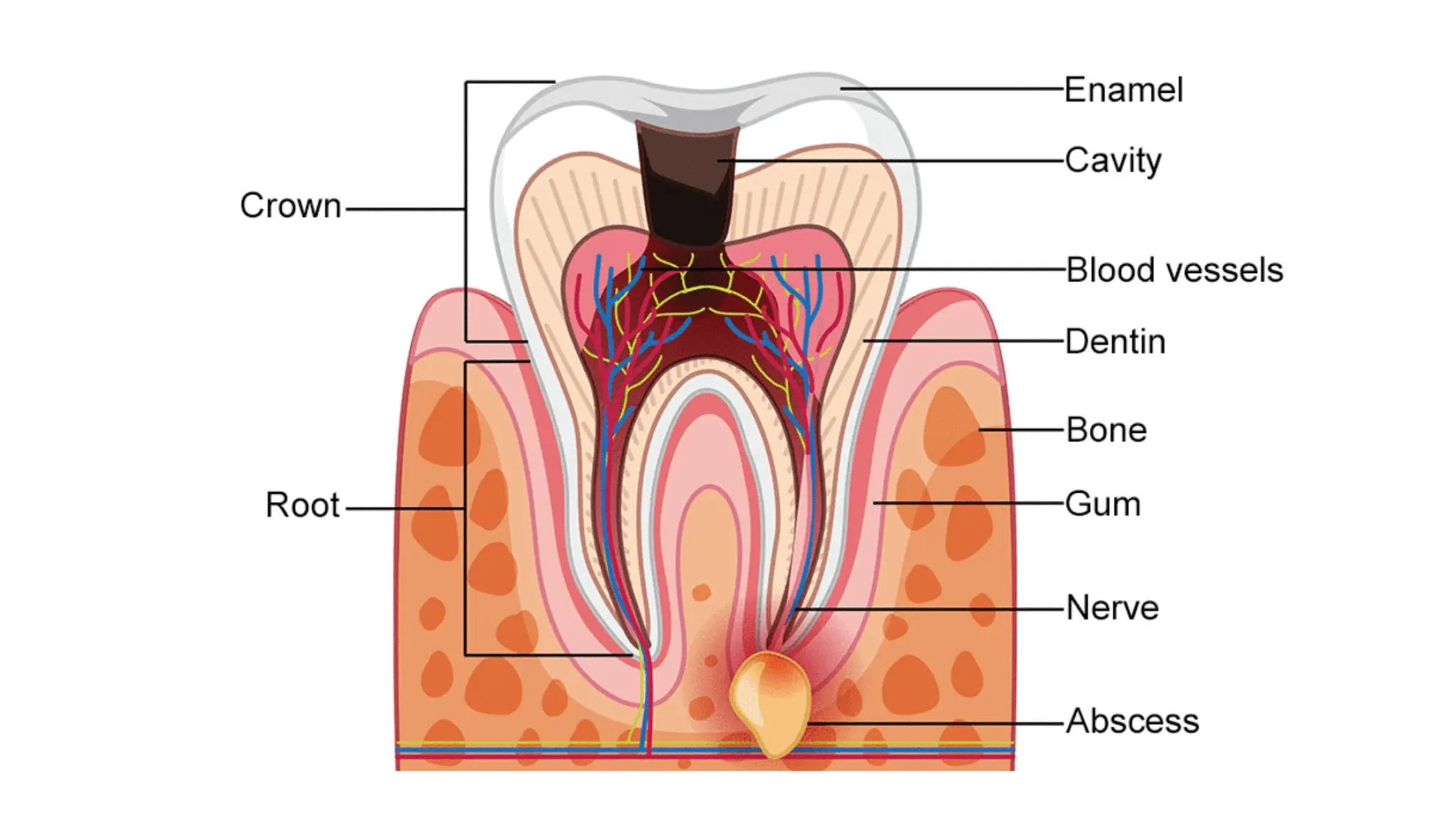 tooth decay Kako spriječiti nastanak karijesa?